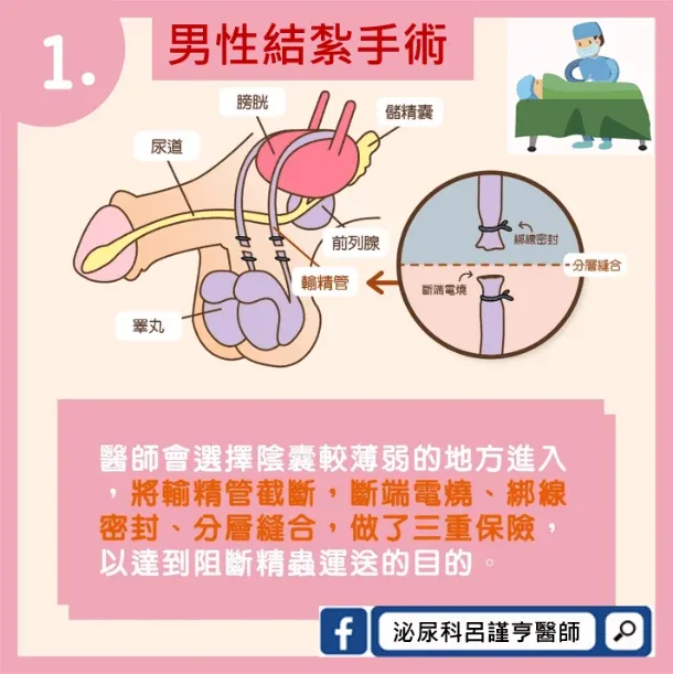顯微微創輸精管重接手術