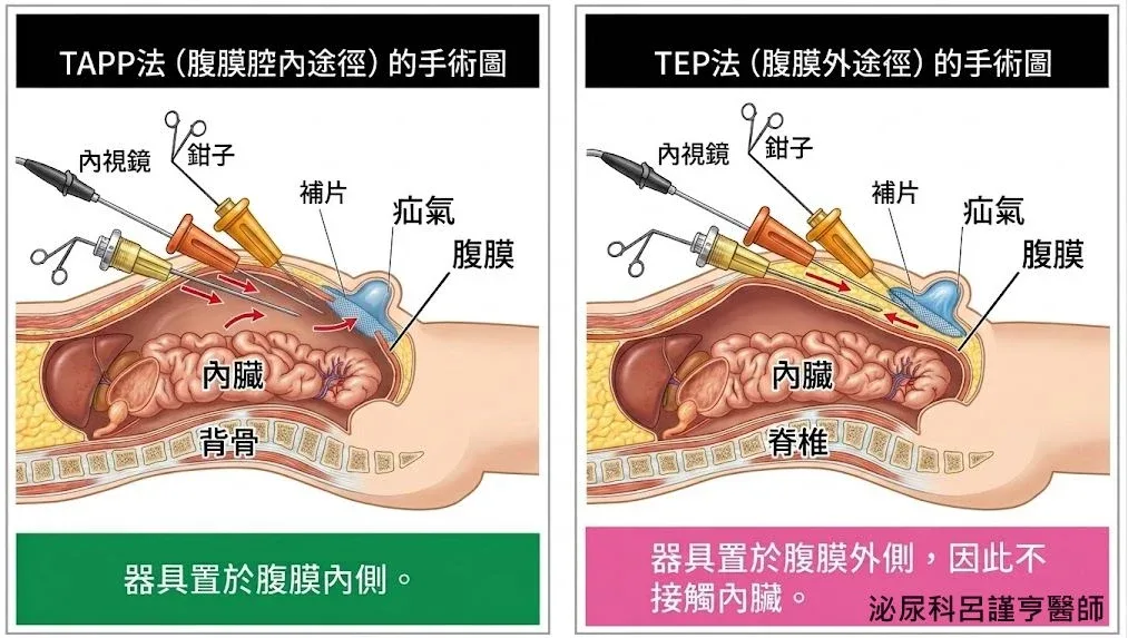 經腹腔與後腹腔腹腔鏡疝氣手術