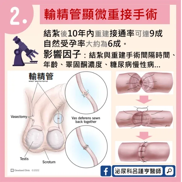 輸精管顯微重接手術